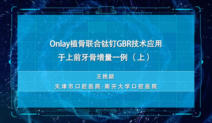 Onlay植骨联合钛钉GBR技术应用于上前牙骨增量一例（上）