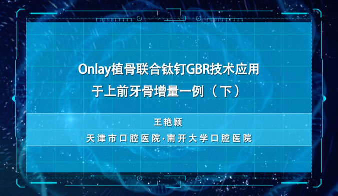 Onlay植骨联合钛钉GBR技术应用于上前牙骨增量一例（下）