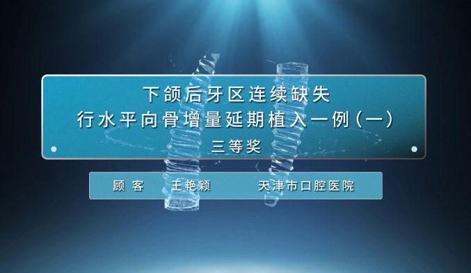 下颌后牙区连续缺失行水平向骨增量延期植入一例（一）