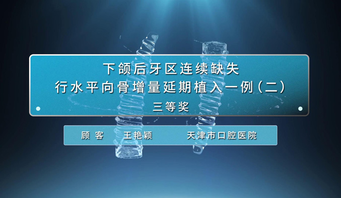 下颌后牙区连续缺失行水平向骨增量延期植入一例（二）