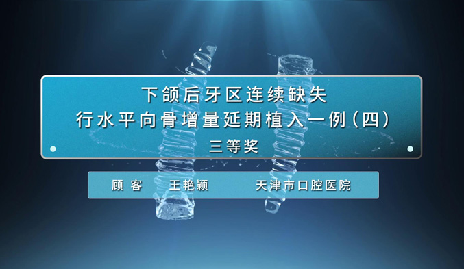 下颌后牙区连续缺失行水平向骨增量延期植入一例（四）