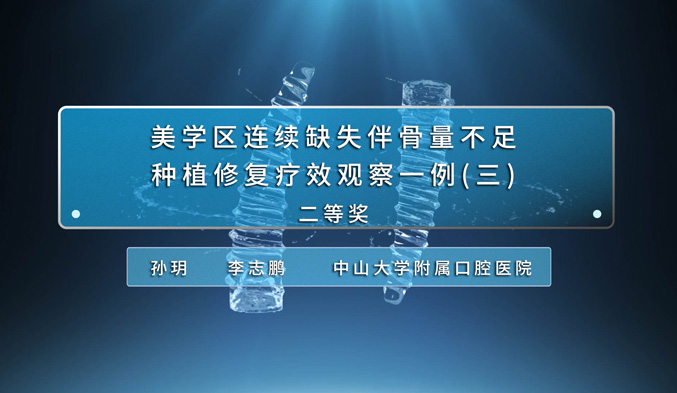 美学区连续缺失伴骨量不足种植修复疗效观察一例（三）