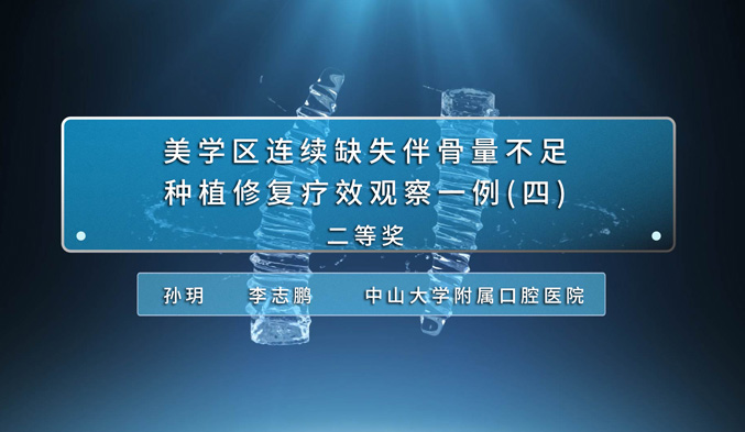 美学区连续缺失伴骨量不足种植修复疗效观察一例（四）