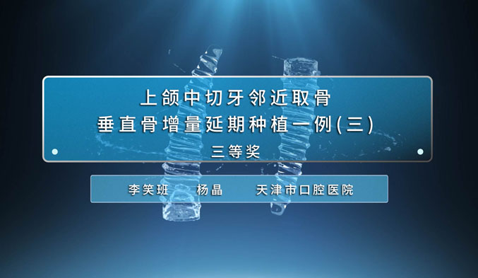 上颌中切牙邻近取骨垂直骨增量延期种植一例（三）