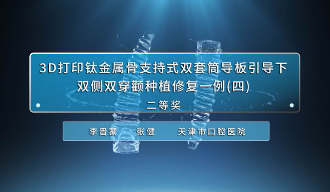 3D打印钛金属骨支持式双套筒导板引导下双侧双穿颧种植修复一例（四）