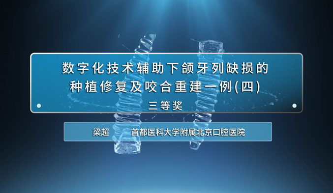 数字化技术辅助下颌牙列缺损的种植修复及咬合重建一例（四）