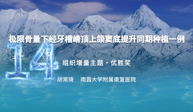 极限骨量下经牙槽嵴顶上颌窦底提升同期种植一例