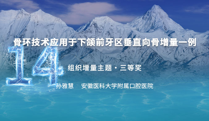 骨环技术应用于下颌前牙区垂直向骨增量一例
