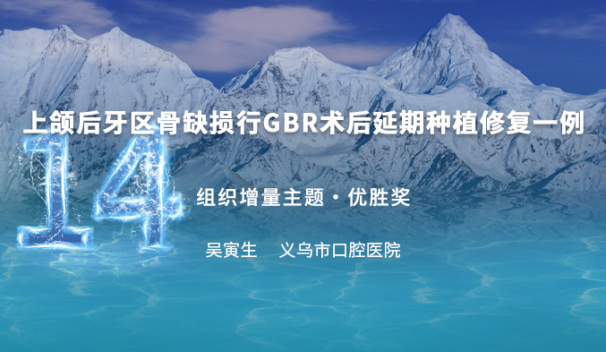 上颌后牙区骨缺损行GBR术后延期种植修复一例
