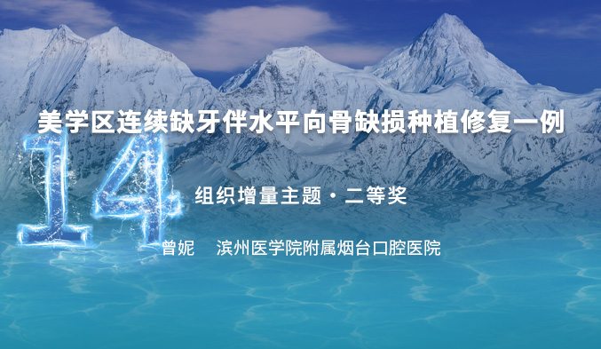 骨劈开技术用于美学区连续缺牙种植修复一例