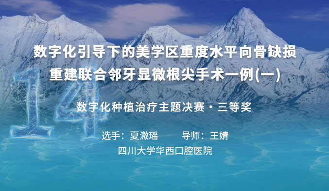 数字化引导下的美学区重度水平向骨缺损重建联合邻牙显微根尖手术一例（一）